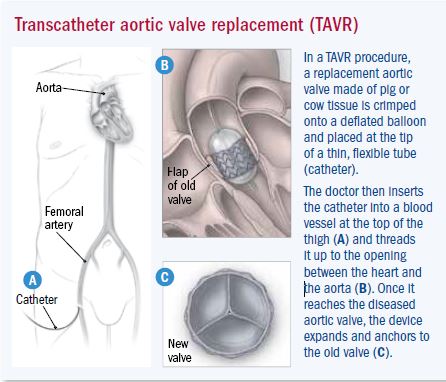 Replacing An Aortic Valve Without Open Heart Surgery Harvard Health