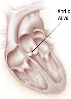 Valve Replacement Mechanical Or Tissue Harvard Health