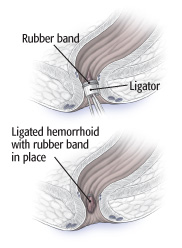 Ligature de l'hémorroïde par élastique