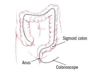 Colon Polyps Harvard Health