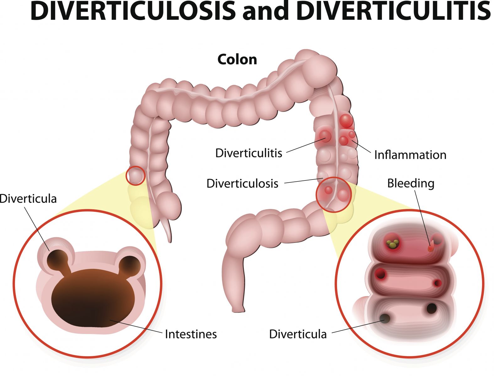 diverticulitis with bleeding