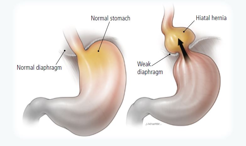 Acid reflux disease surgery complications