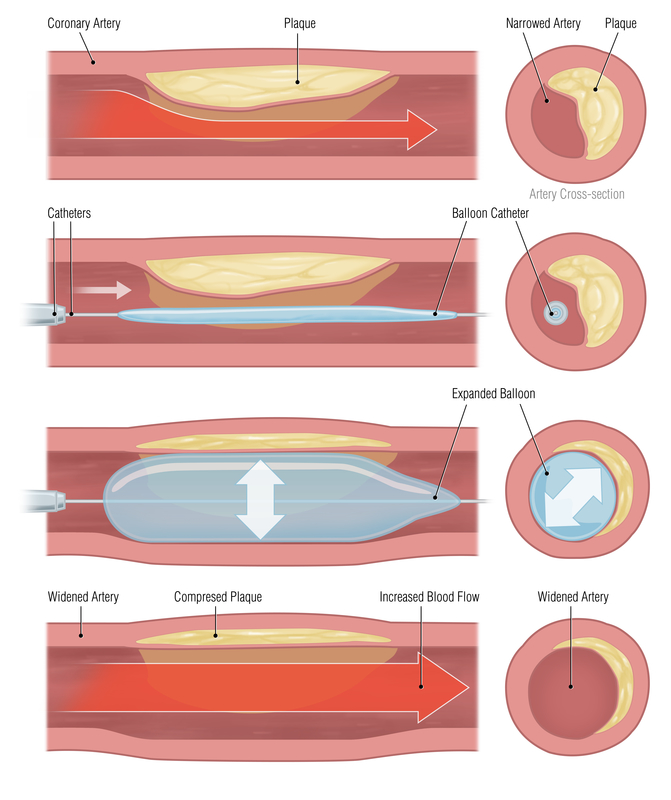 Diet Chart For Angioplasty Patient