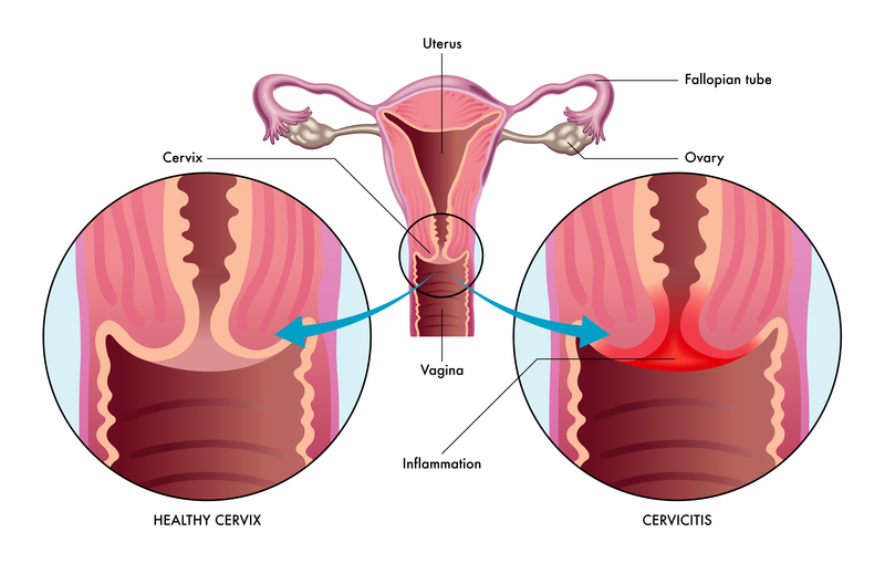 Cervicitis - Harvard Health