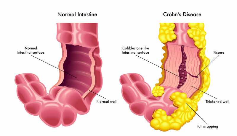 ãCrohn's diseaseãçåçæå°çµæ