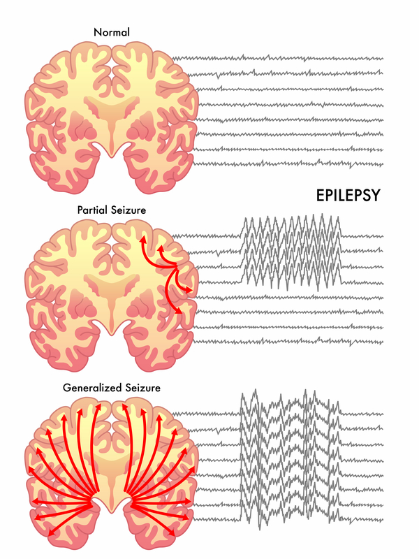 Diet Chart For Epilepsy Patient