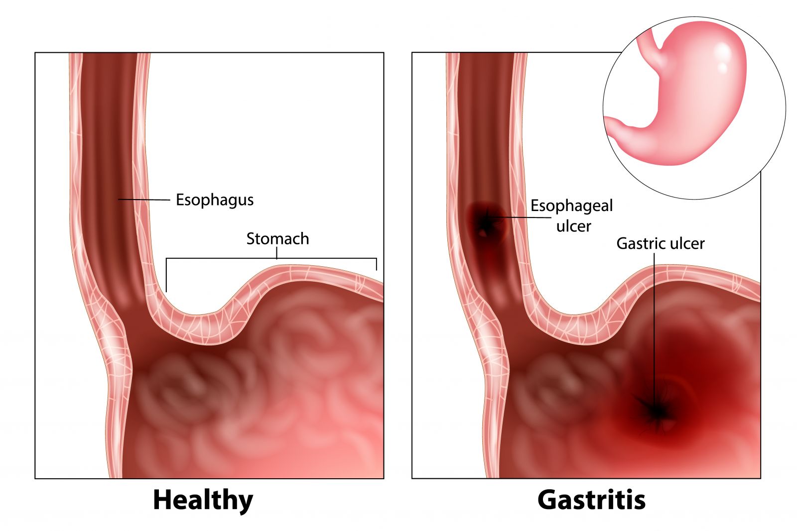 Gastritis Stool Type
