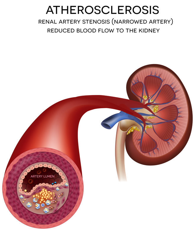 End-Stage Renal Disease - Harvard Health