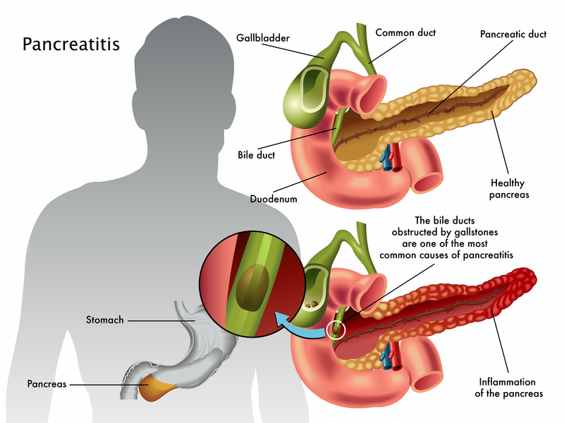 Chronic Pancreatitis Harvard Health