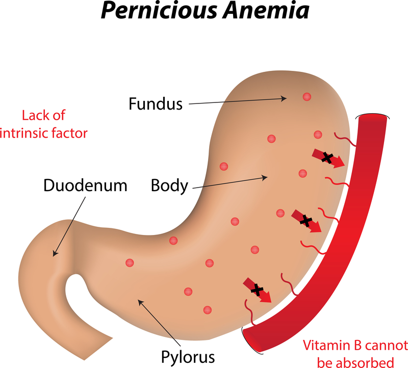 Vitamin B12 Deficiency Harvard Health