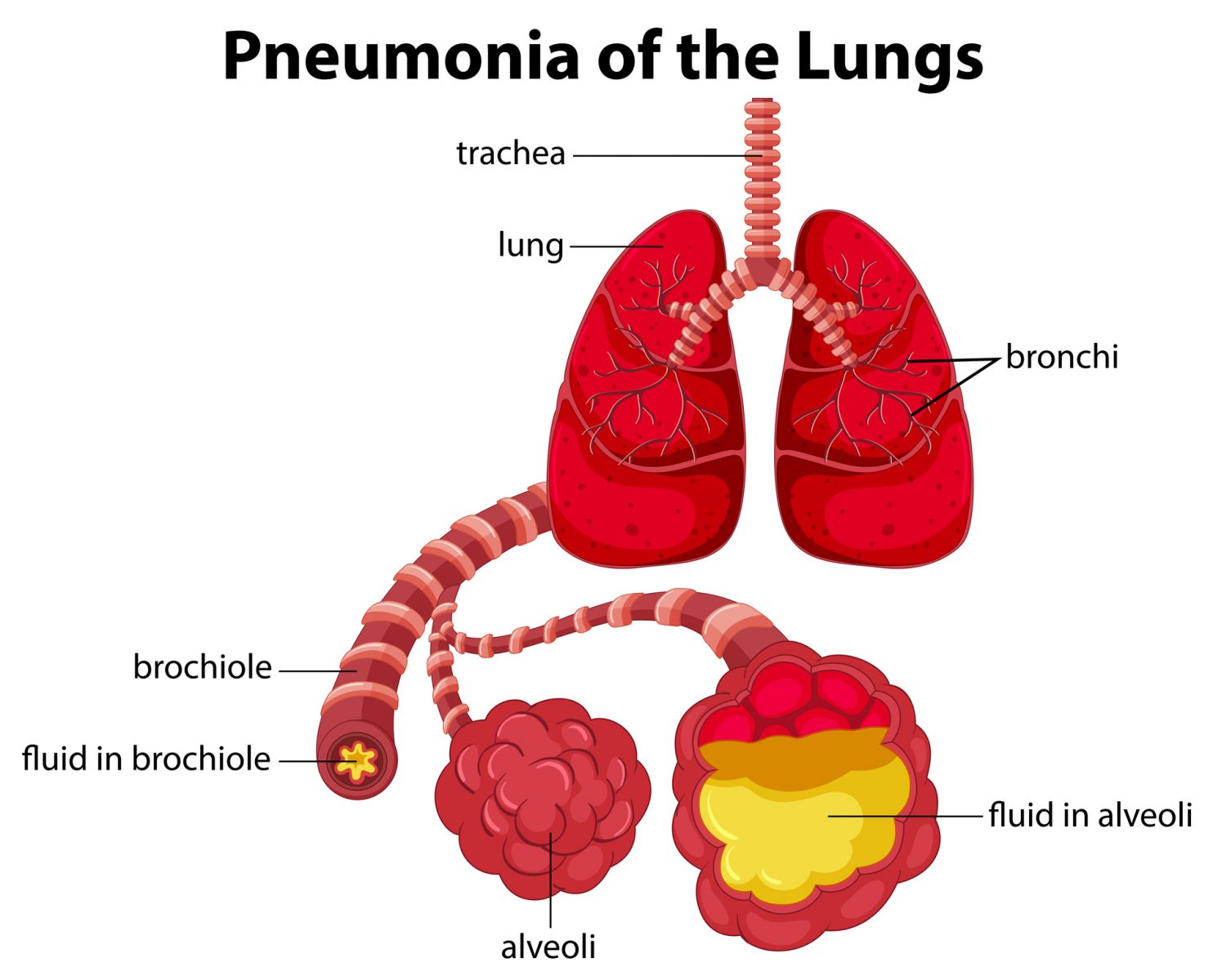 Pneumonia Gettyimages 1010467510
