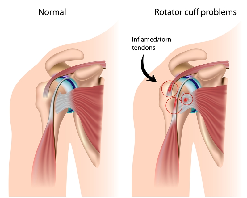 torn shoulder