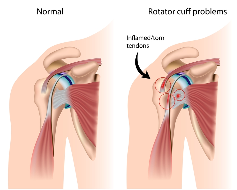 Rotator Cuff Injury - Harvard Health