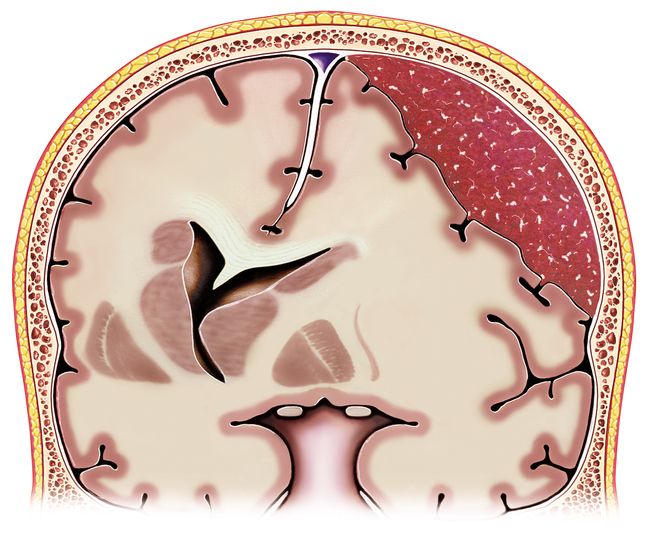 Concept Map Pdf Nursing Concept Map Subdural Hematoma Pathophysiology