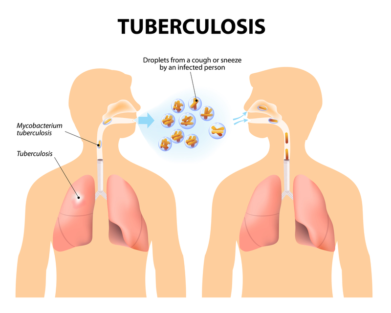 Tuberculosis Harvard Health