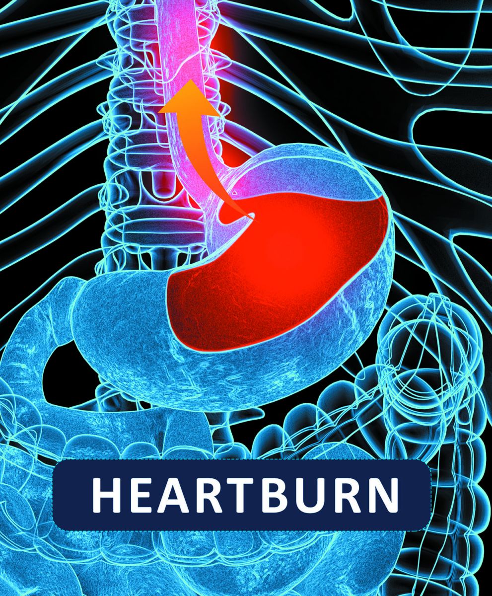 Acid reflux and right chest pain