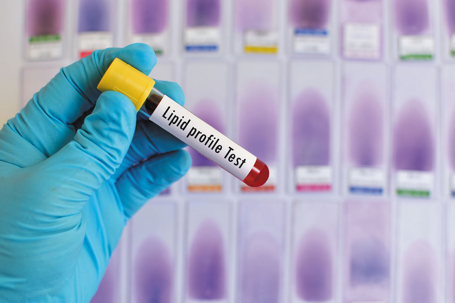 Non Hdl Cholesterol Chart