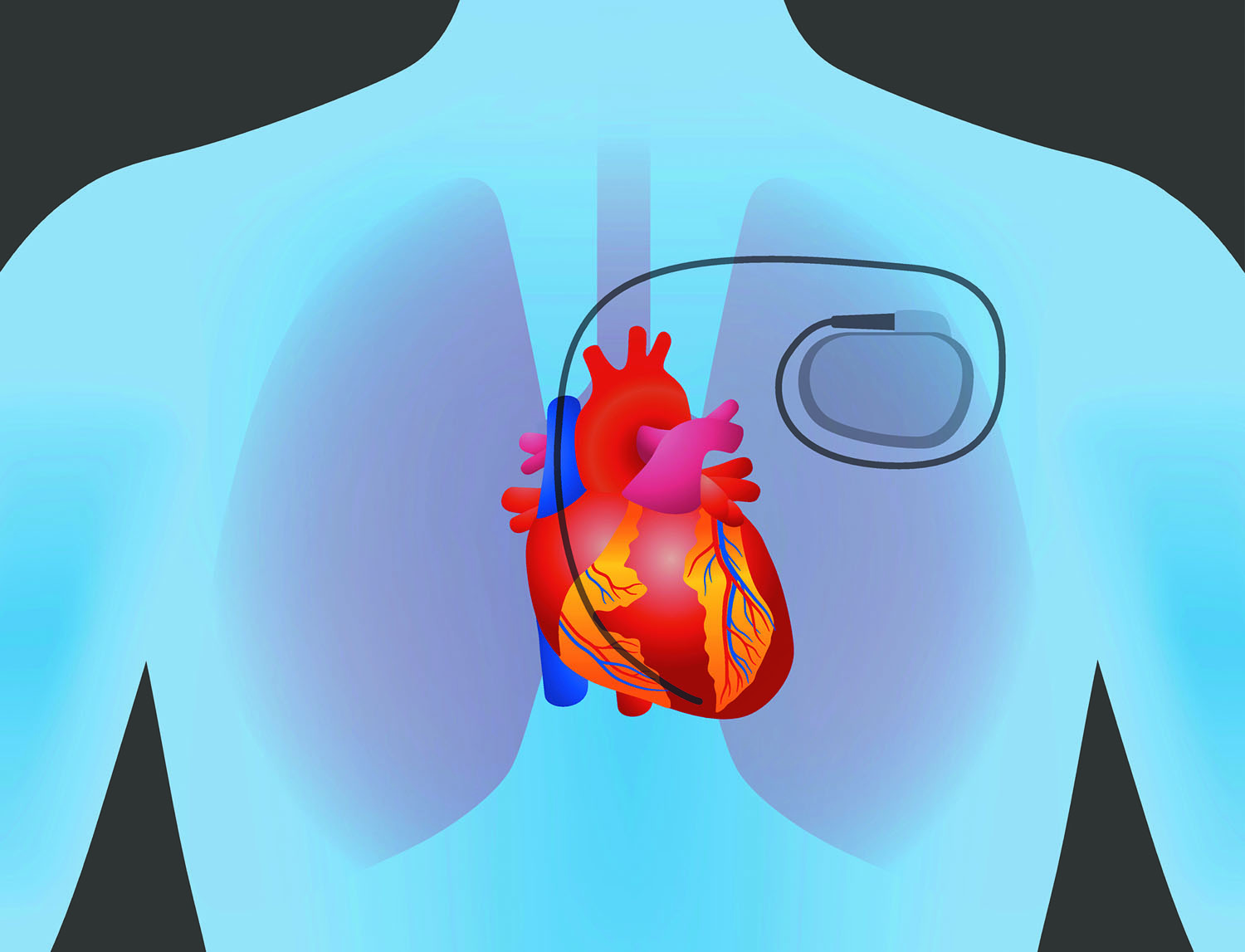 Can Your Heart Skip A Beat With A Pacemaker Don T Fear Pacemakers Harvard Health
