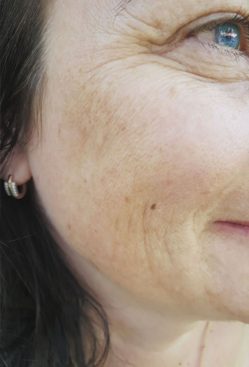 Unmasking the causes and treatments of melasma - Harvard ...