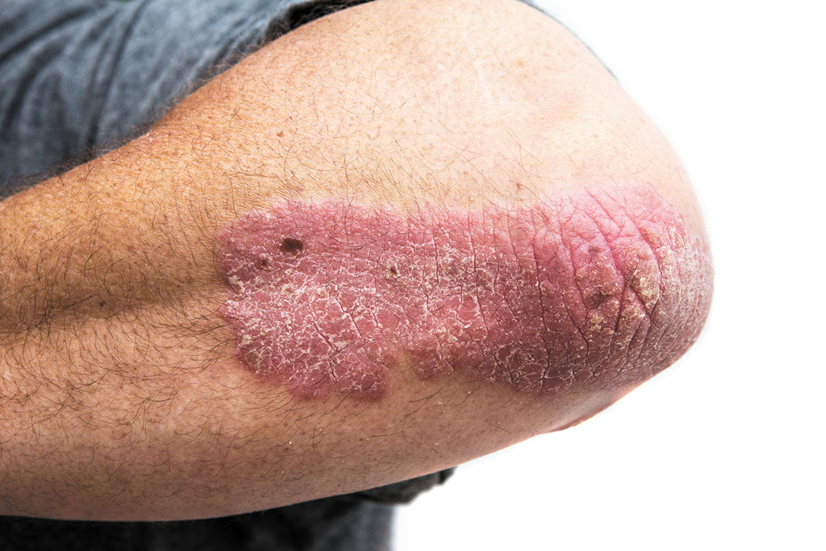 A Deeper Look At Psoriasis Harvard Health