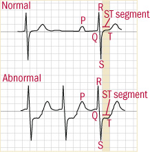 Stress Test Target Heart Rate Chart