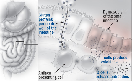 Celiac Intestines