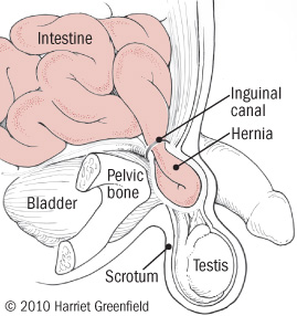 Can Hernias Fix Themselves