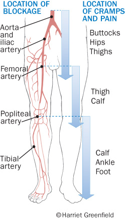 Peripheral Artery Disease Leg Pain And Much More Harvard Health