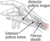 tendon trouble in the hands de quervain s tenosynovitis and trigger