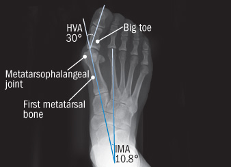 x-ray of a foot with a bunion