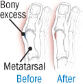 illustration of repair to mild bunion