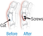 illustration of repair to moderate bunion