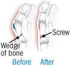 illustration of repair to severe bunion