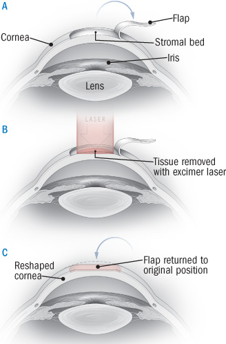 Eye Surgery Orlando