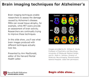 Brain imaging techniques for Alzheimer s disease Harvard Health Brain imaging techniques for Alzheimer s disease Harvard Health